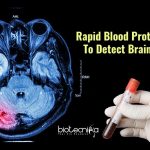 Rapid Blood Protein Test To Detect Brain Injury In 15 Minutes blood test for brain injury