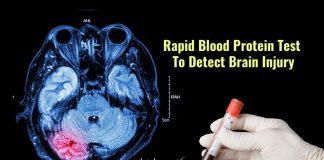 blood test for brain injury