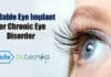 Refillable Eye Implant For Chronic Eye Disorder From Roche Roche's eye implant