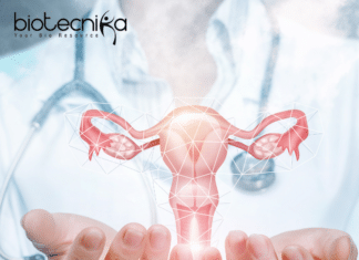 Ovarian cancer