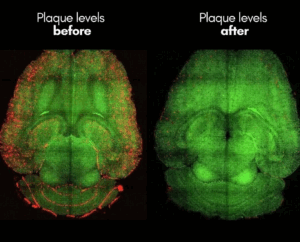 Plaque levels before and after