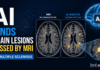 AI Finds Brain Lesions Missed by MRI in Multiple Sclerosis AI revealed more than 11,000 Hidden Brain Lesions in Multiple Sclerosis patients, Exposing Damage that Standard MRI Scans Failed to Detect.