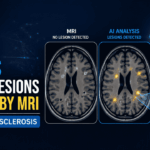 AI revealed more than 11,000 Hidden Brain Lesions in Multiple Sclerosis patients, Exposing Damage that Standard MRI Scans Failed to Detect.