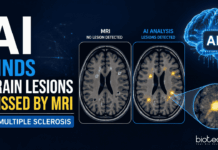 AI revealed more than 11,000 Hidden Brain Lesions in Multiple Sclerosis patients, Exposing Damage that Standard MRI Scans Failed to Detect.