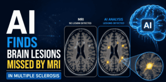 AI revealed more than 11,000 Hidden Brain Lesions in Multiple Sclerosis patients, Exposing Damage that Standard MRI Scans Failed to Detect.